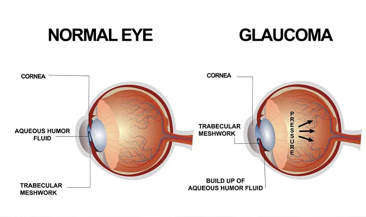 A comparison image of a clear vision and a vision blurred by cataracts.
