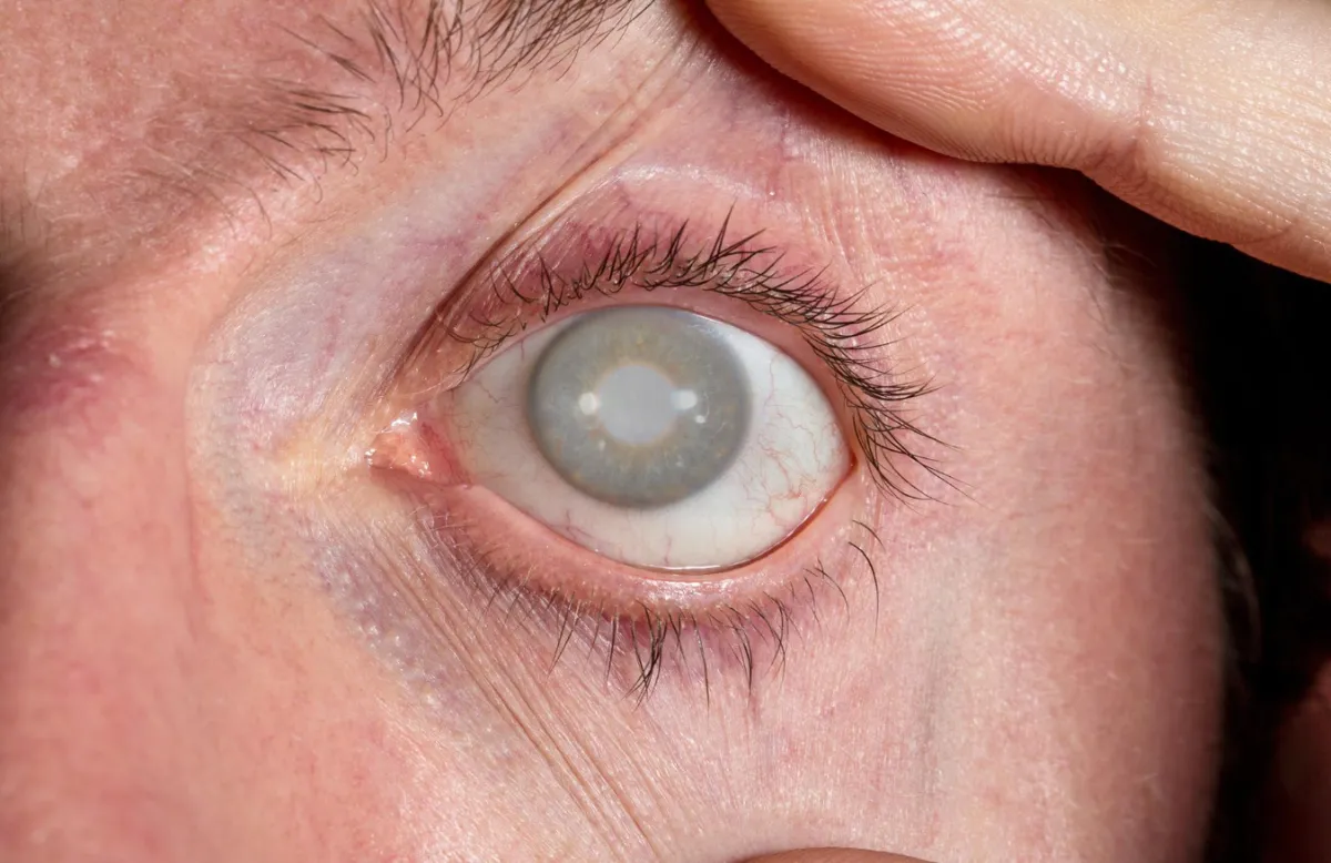 Refractive Surgery