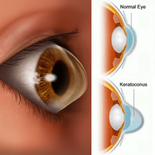 Corneal Diseases