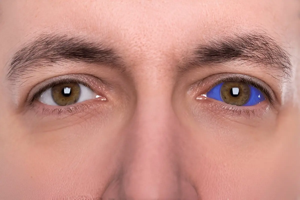 Pterygium