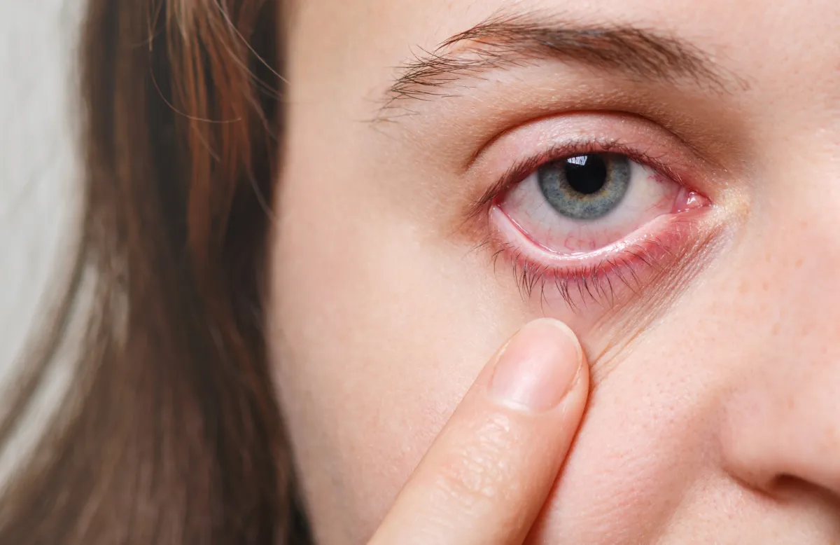 Refractive Surgery