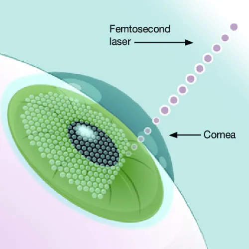 Femtosecond Laser Cataract Surgery