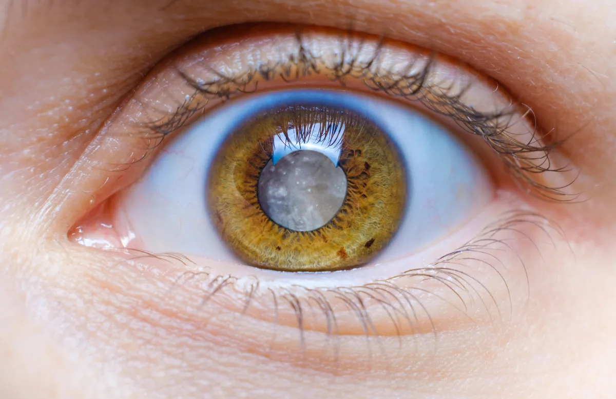 Refractive Surgery