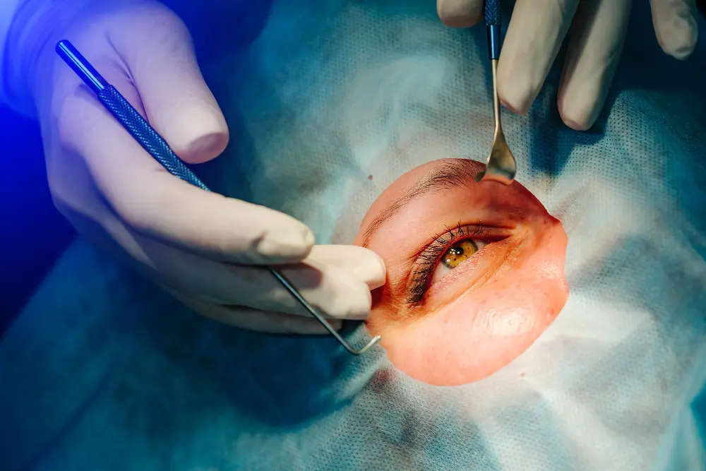 Pterygium