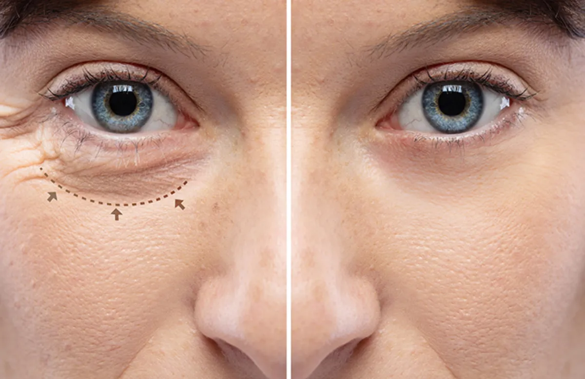 Refractive Surgery