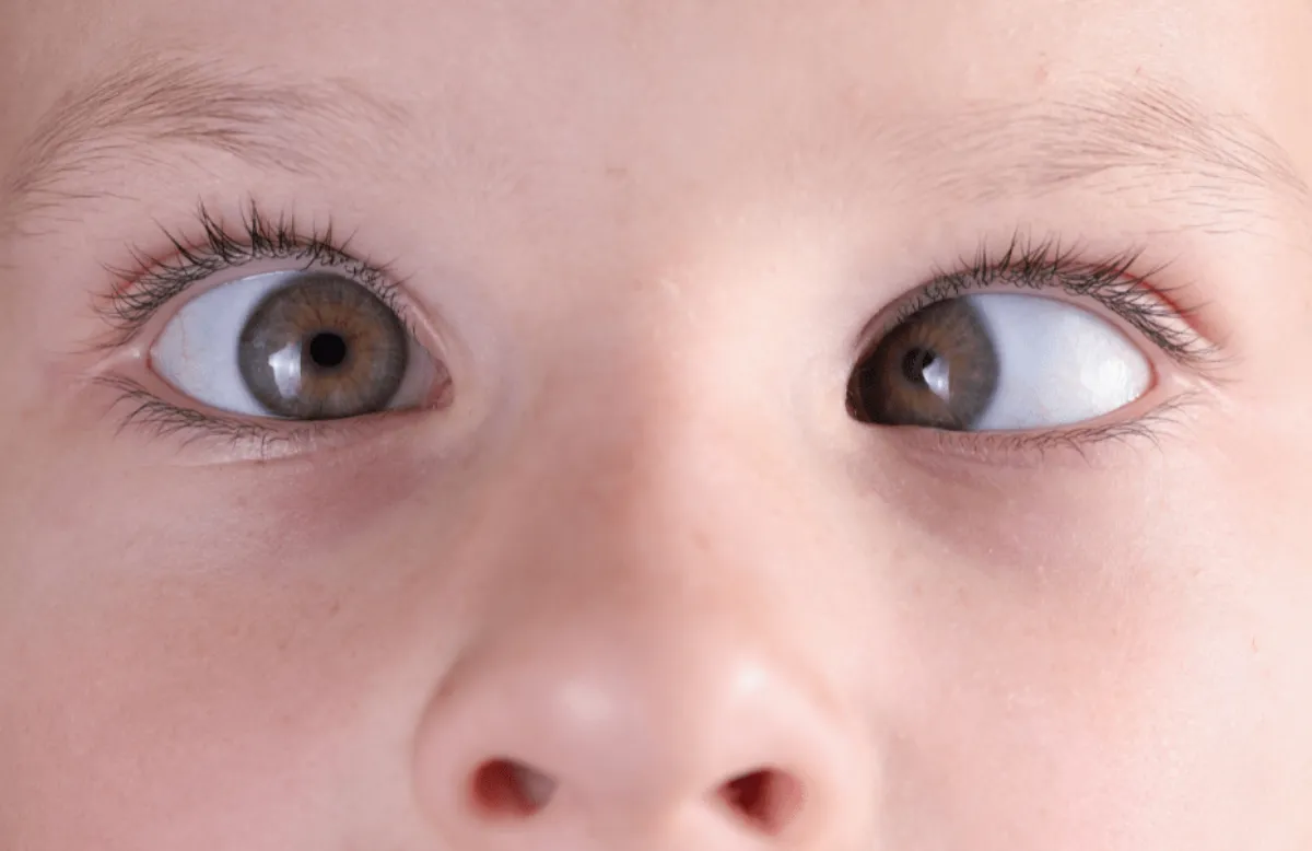 Refractive Surgery