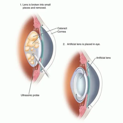 Phacoemulsification Surgery