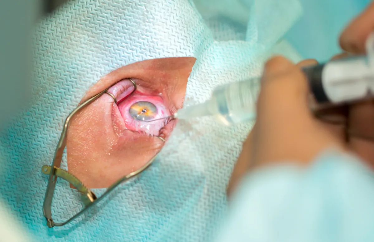 Refractive Surgery
