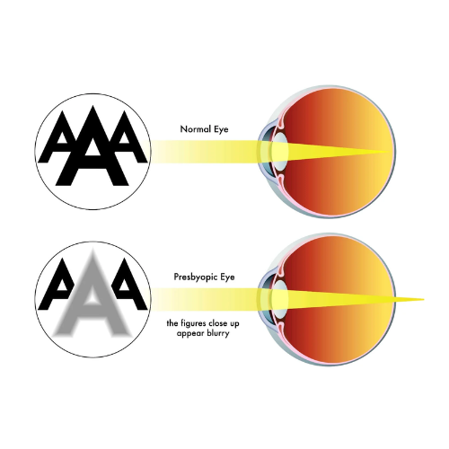 Corneal Diseases