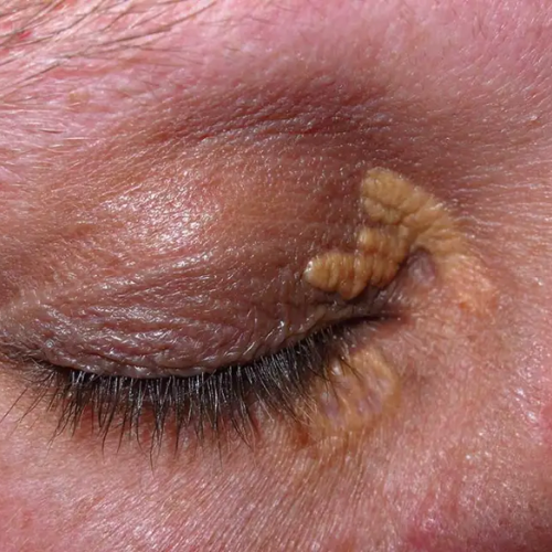 Optic Nerve Conditions