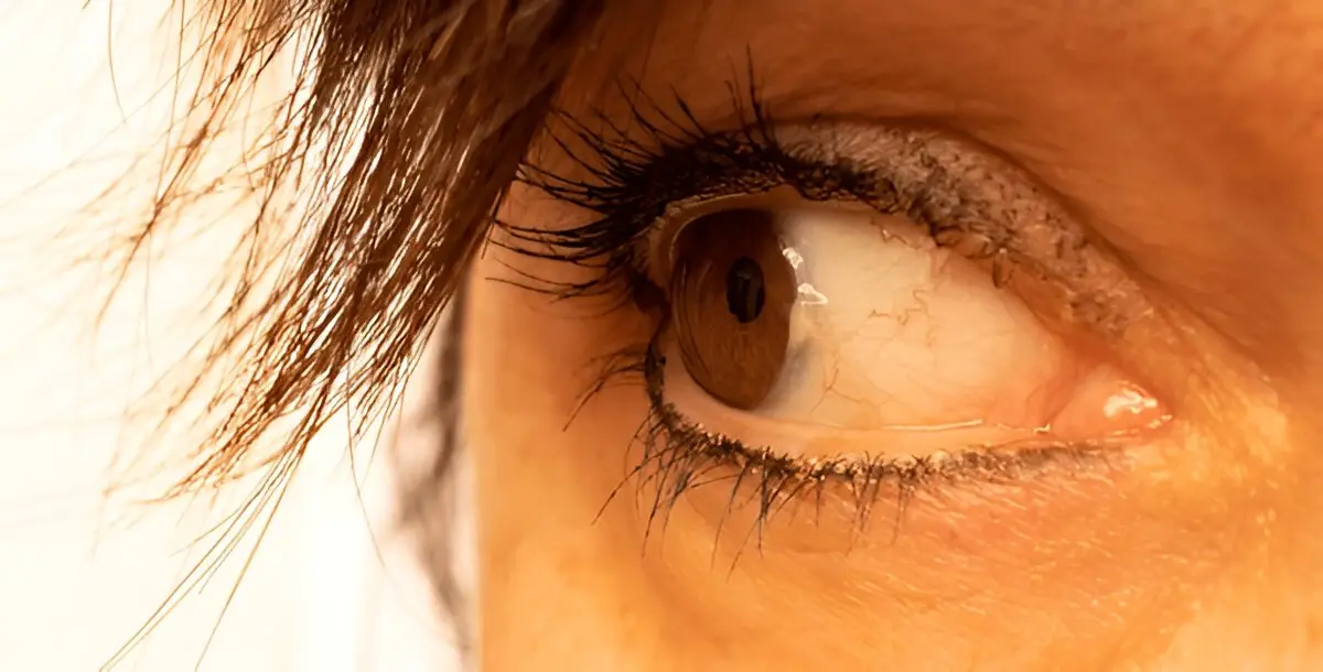 Pterygium