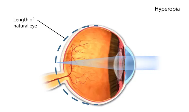 A comparison image of a clear vision and a vision blurred by cataracts.
